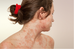 Ekcem i atopijski dermatitis: Zašto ima smisla posegnuti za dermonutraceutikom
