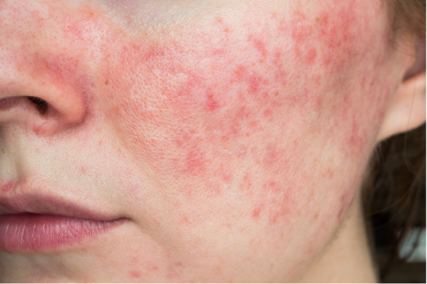ROSACEA: Kada lice gori i samopouzdanje pada: ključ može biti kontrola histamina?
